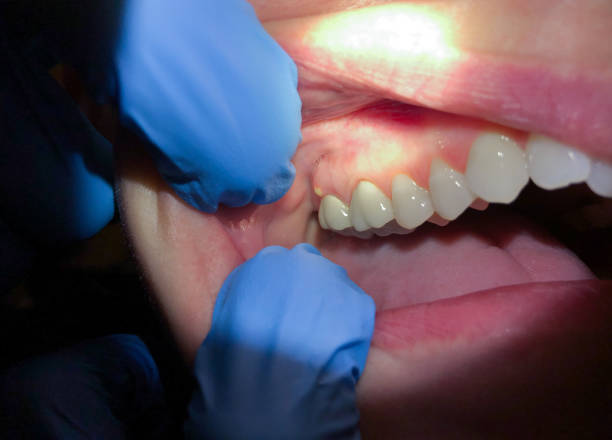 Best Emergency Tooth Extraction in Frankfort Square, IL